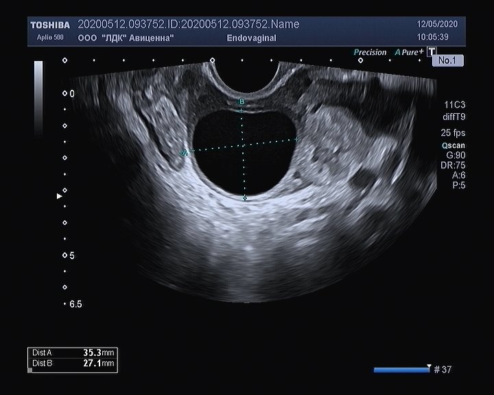 На узи видно внематочную. Внематочная беременность на УЗИ. Трубная беременность УЗИ. Эктопическая беременность УЗИ. УЗИ матки при трубной беременности.